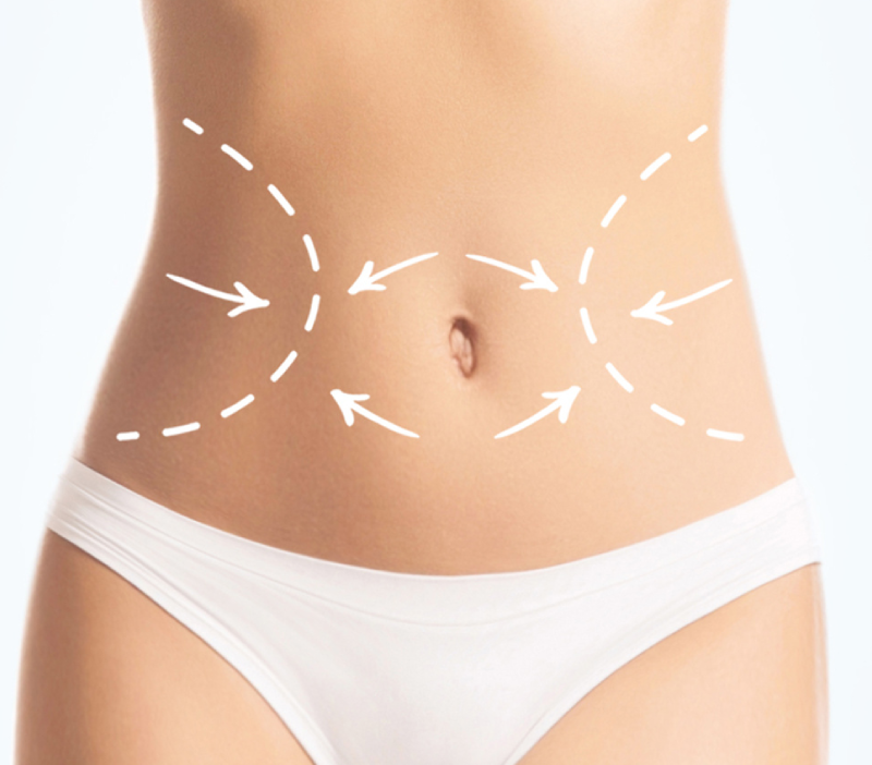 abdominoplastie